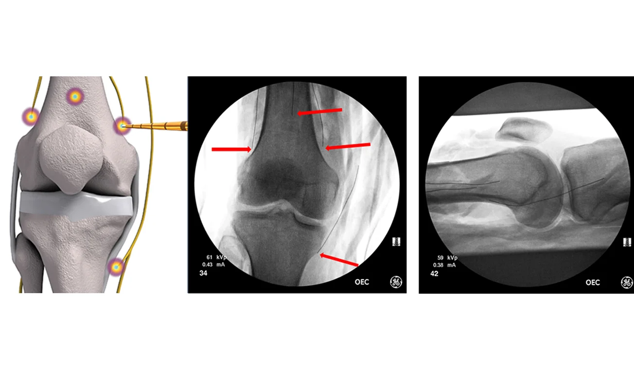 Treatment of Osteoarthritis of Knee joints by Radiofrequency Ablation ...