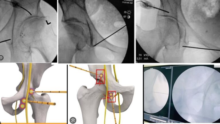 Pain management of avascular necrosis with radiofrequency ablation technique