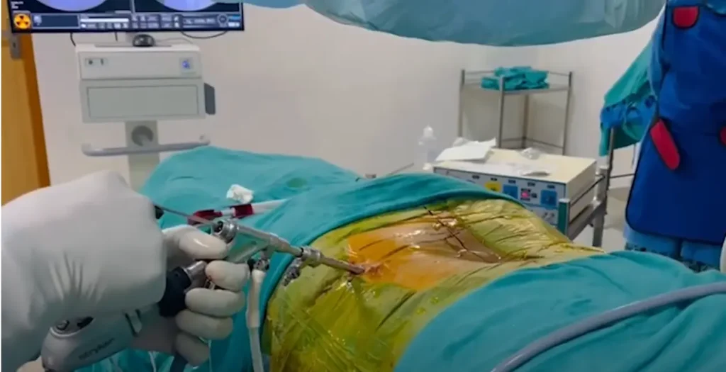 Transforaminal Endoscopic Discectomy Technique Dr Manohar Lal Sms