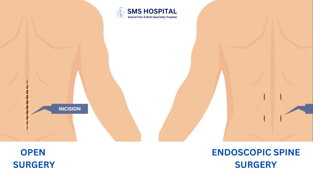 Endoscopic Spine Surgery