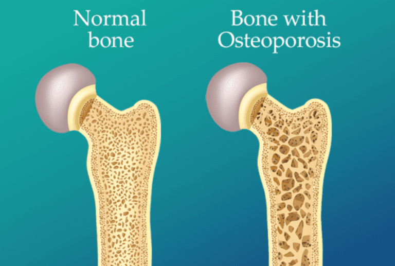 Osteoporosis