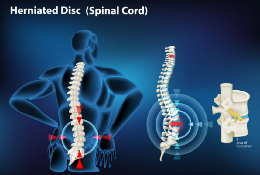 Slip Disc Treatment