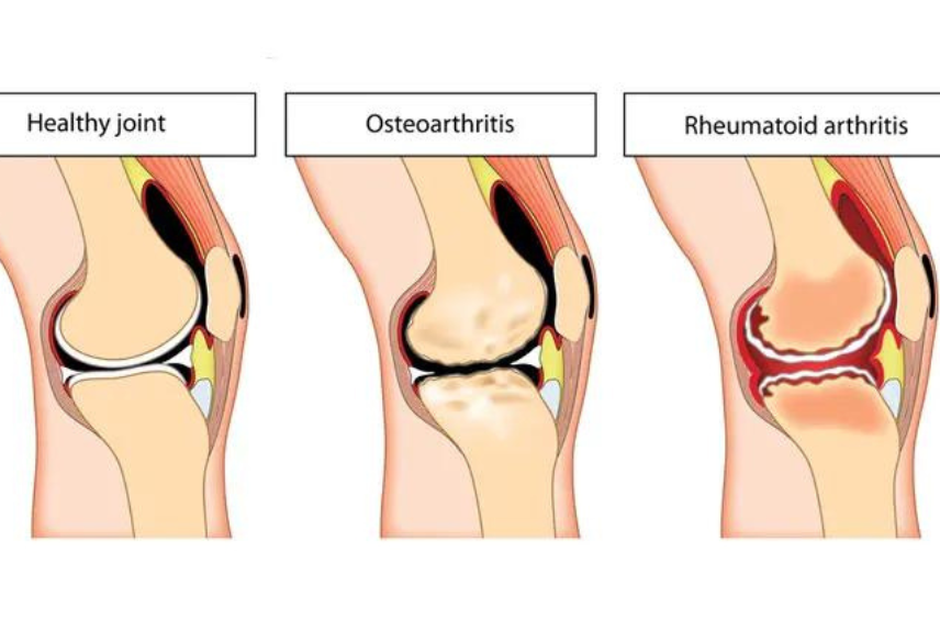 Knee Pain Treatment