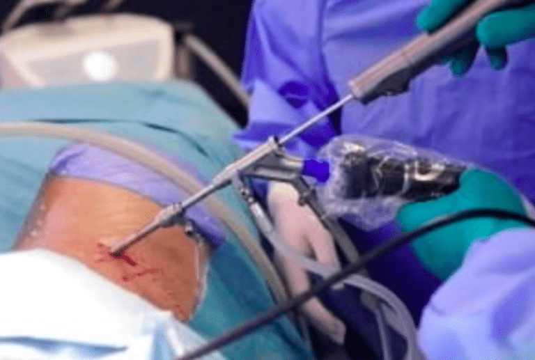 Endoscopic Spine Surgery